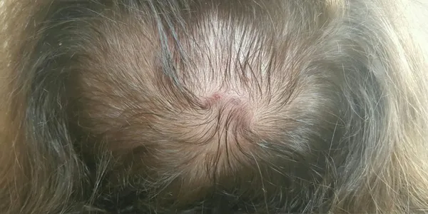 Haaransatzverdichtung_Nachher