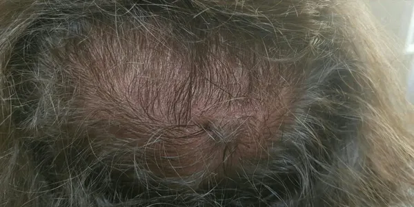 Haaransatzverdichtung_Vorher