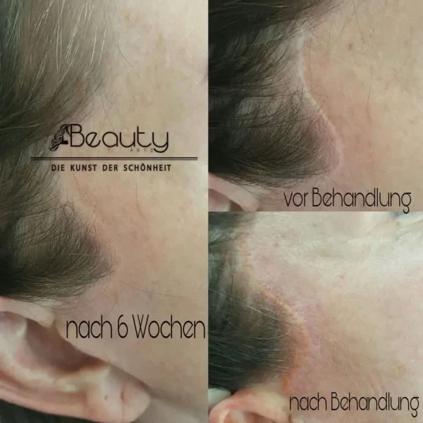 Narbenkaschierung_Beispiel