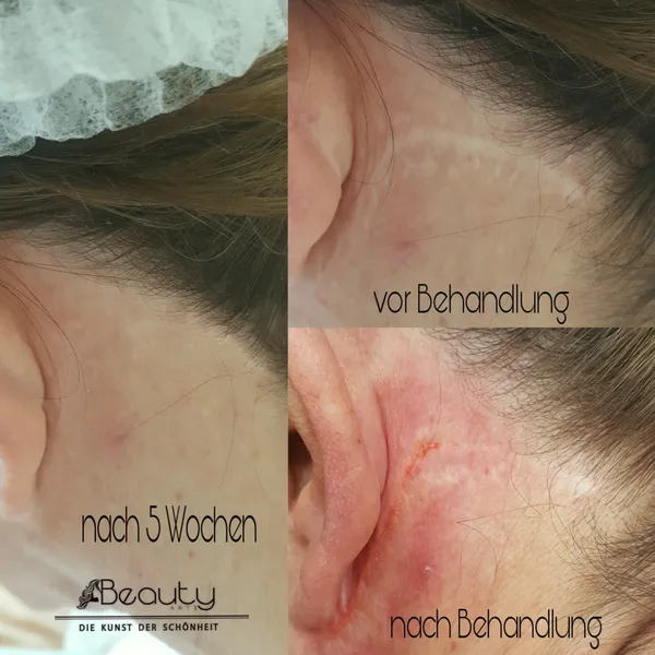 Permanent_Make_Up_Narbenkaschierung_Vergleich